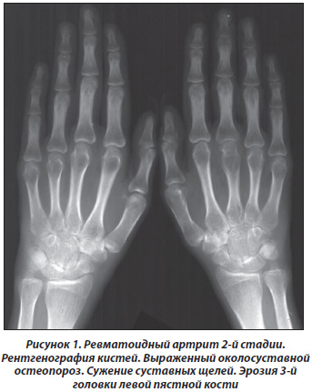 Рентгенологическая картина при ревматоидном артрите