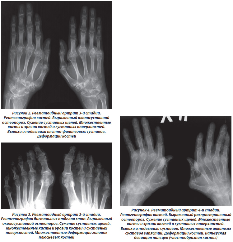 Ревматический полиартрит рентгенологическая картина