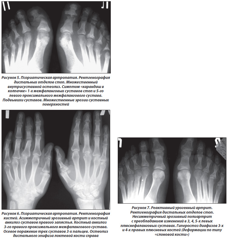 Ревматический полиартрит рентгенологическая картина