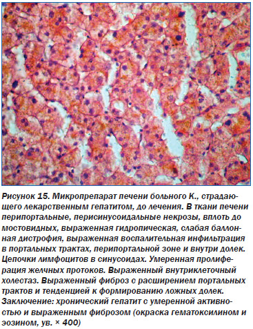 Первые признаки цирроза печени