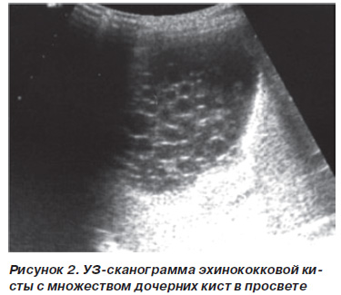 Альвеококкоз печени узи картина