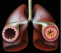 Прогнозування тяжкого перебігу бронхіальної астми  у дітей