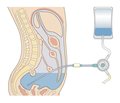 ISPD guidelines for peritoneal dialysis in acute kidney injury: 2020 Update (paediatrics)