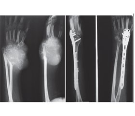 Гігантоклітинна пухлина дистального відділу променевої кістки, результати хірургічного лікування