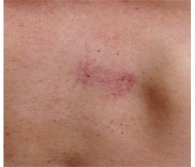 Т-клеточная лимфома кожи: «обезглавленный грибовидный микоз».