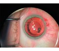 Calculation of tunnel incision parameters during phacoemulsification in patients with previous anterior radial keratotomy
