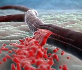 Роль диссекции сонных и позвоночных артерий в развитии цереброваскулярных нарушений