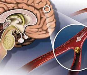 Диагностика и лечение ишемии головного мозга (Сергиев Посад)