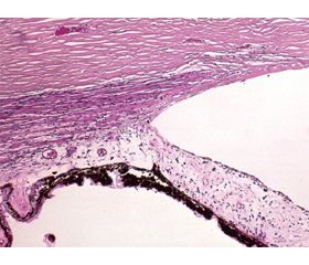 Глаукома з кутовою рецесією: деякі питання етіології, патогенезу, клініки та лікування