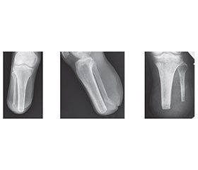 Стресові переломи кісток ампутаційних кукс нижніх кінцівок: клініко-рентгенологічні та морфологічні особливості