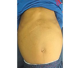 Автоімунний гепатит у дитини з попередніми гепатобластомою та гепатектомією: рідкісний клінічний випадок і огляд літератури