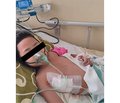 Тяжка дифтерія з міокардитом: клінічний випадок