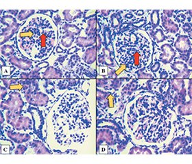 Гістопатологічні закономірності та клінічна варіабельність при гострому проліферативному гломерулонефриті в дітей: опис чотирьох випадків
