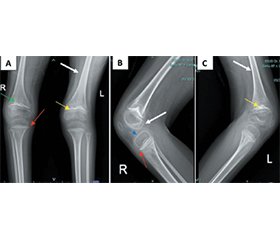 Цинга, що імітує прогресування дитячого церебрального паралічу: тяжкий дефіцит вітаміну С та функціональне відновлення в дитини зі спастичною диплегією. Клінічний випадок